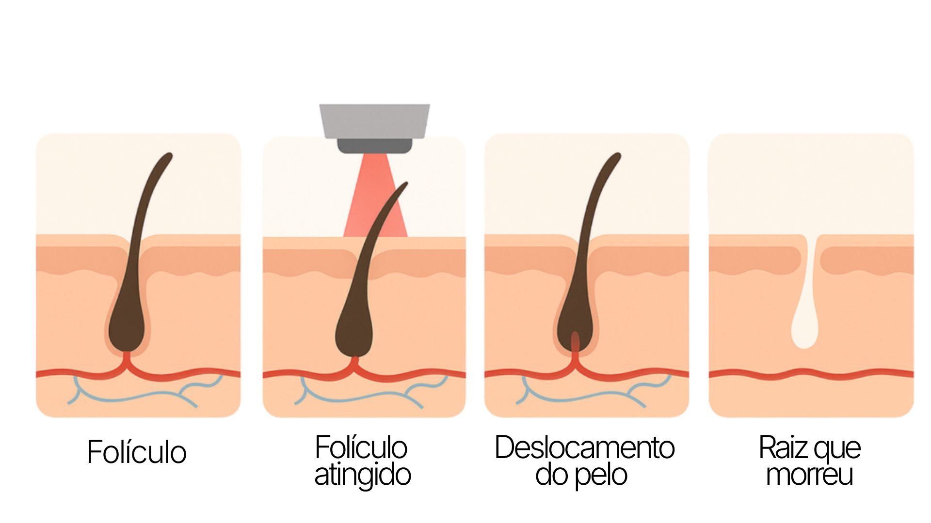 Ilustração do processo de depilação a laser atingindo o folículo piloso