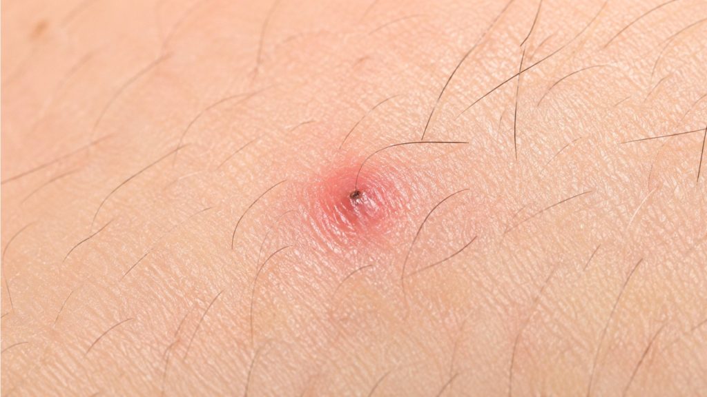 pele com pelos encravados e vermelhidão na região