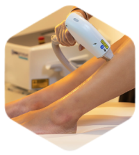 Depilação a Laser Depyl Action